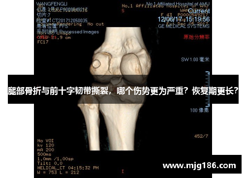 腿部骨折与前十字韧带撕裂，哪个伤势更为严重？恢复期更长？